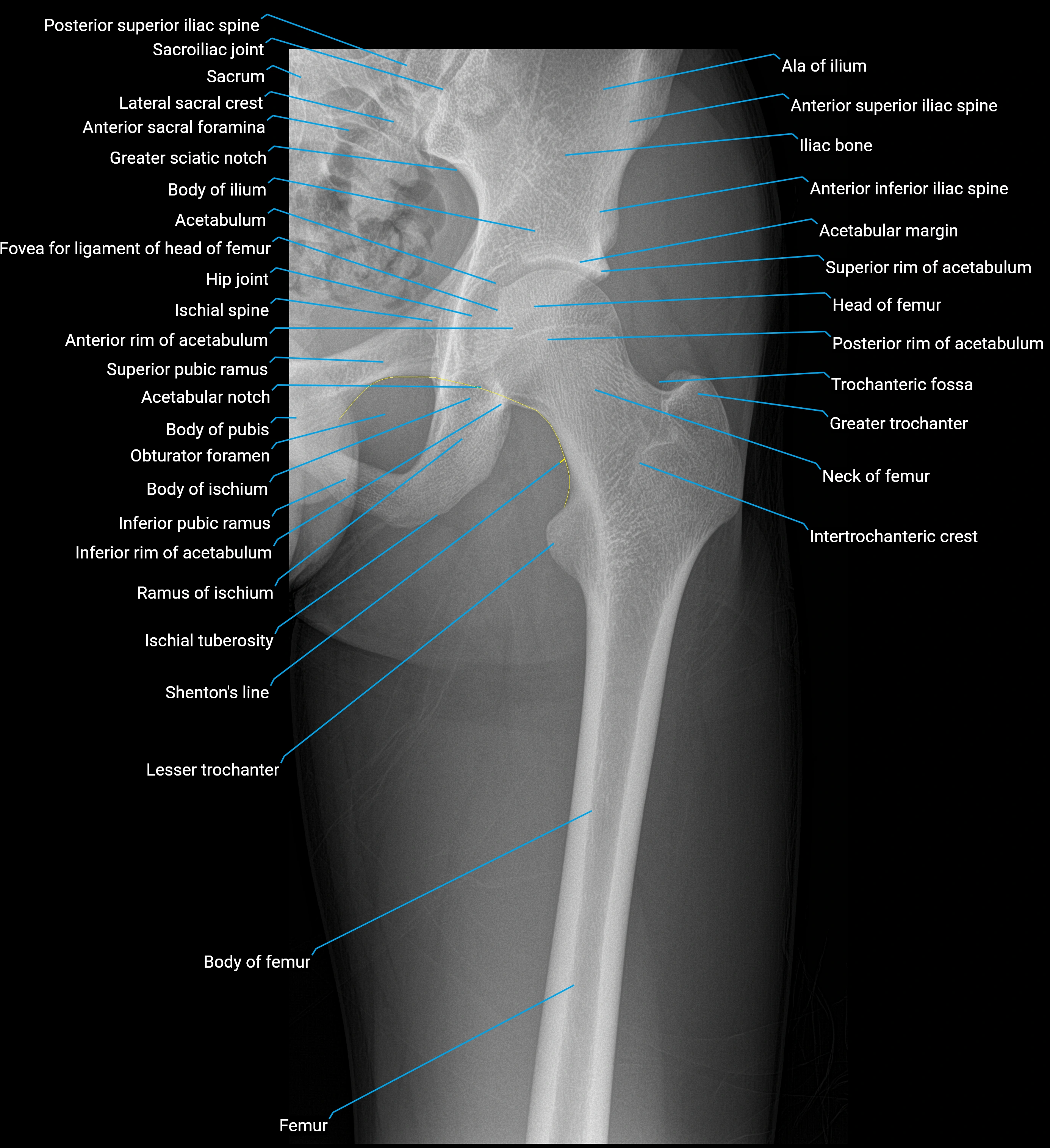 X ray femur AP  anatomy labelled image 1.webp